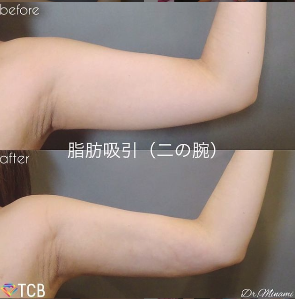 TCBの二の腕の脂肪吸引症例写真