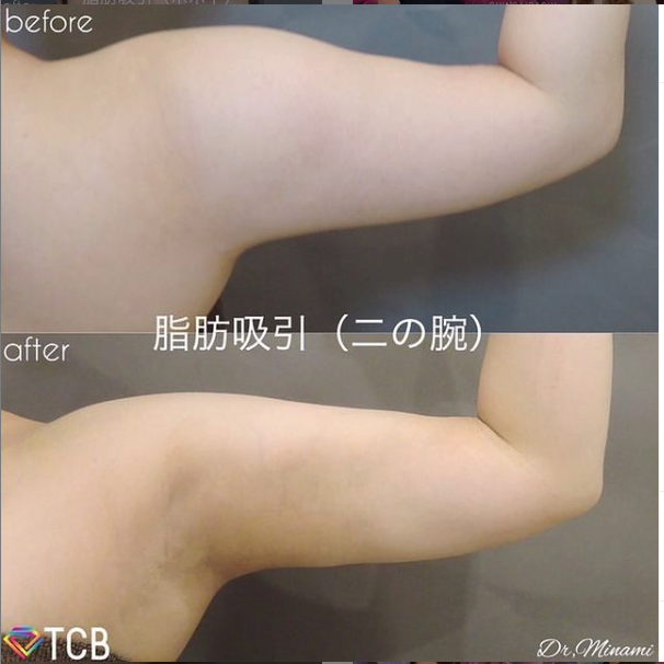 TCBの二の腕の脂肪吸引症例写真