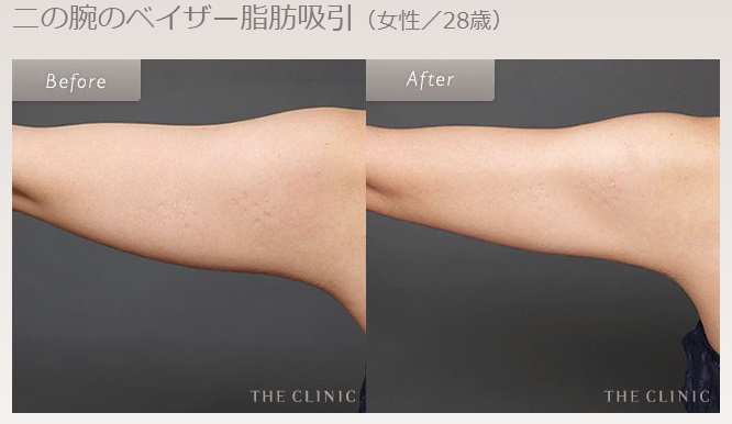 THE CLINICの二の腕の脂肪吸引症例写真