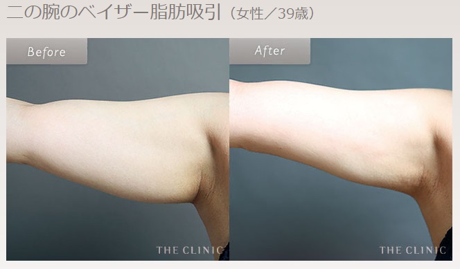 THE CLINICの二の腕の脂肪吸引症例写真