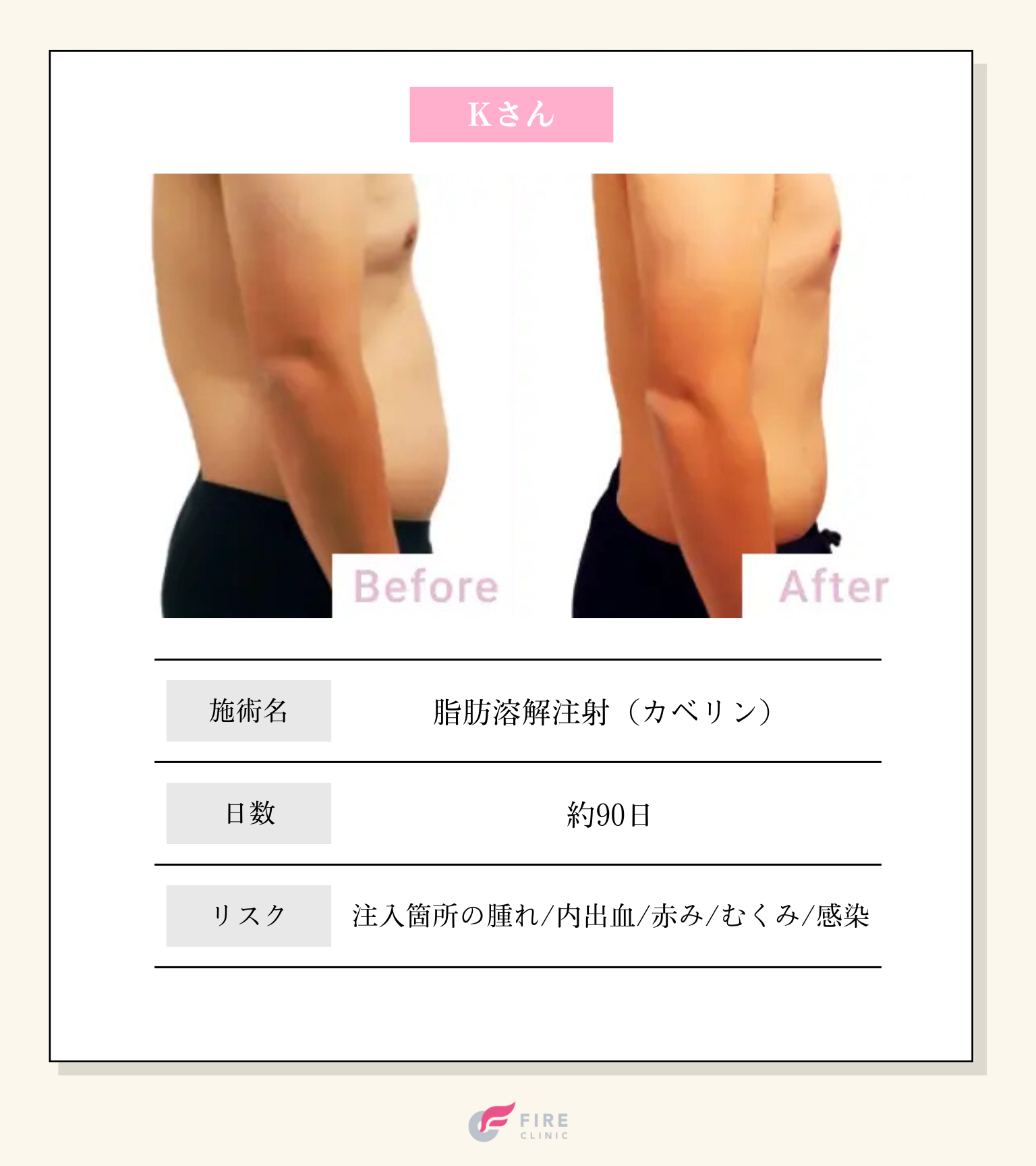 脂肪溶解注射の効果はいつから？