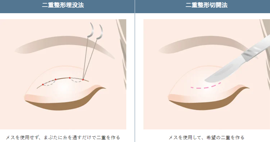 TCBの二重整形の方法