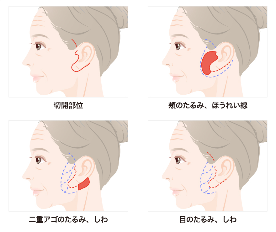 フェイスリフトの施術を受ける